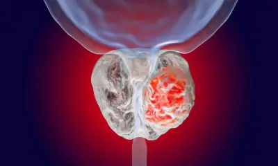 دراسة تحذر: جزيئات البلاستيك الدقيقة تتراكم في بروستات مرضى السرطان