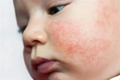 دراسة جديدة تكشف: الإكزيما المبكرة عند الأطفال مرتبطة بضعف مناعة الجلد عند الرضع