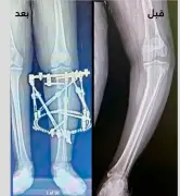 نجاح طبي متميز: فريق جراحة العظام بمدينة الملك سلمان يعيد قدرة المشي لشاب بعد تقوس حاد بالساق