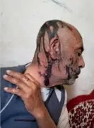 جريمة مروعة في عمران: مسلحان حوثيان يحرقان والدهما المسن بمادة الأسيد