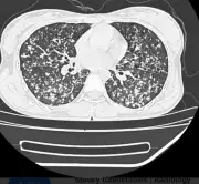 فريق طبي بمستشفى المانع بالأحساء ينقذ مريضاً مصاباً بسل رئوي منتشر ونقص حاد بالأكسجين