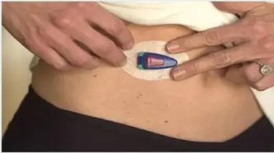 وزارة الصحة السعودية تطلق برنامجاً وطنياً للكشف المبكر عن سرطان الثدي