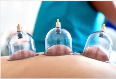 المركز الوطني للطب البديل: الحجامة لا تفطر الصائم شرعاً وقد تضعف صحته نهار رمضان