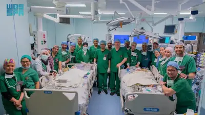 إتمام المرحلتين الرابعة والخامسة من عملية فصل التوأم الفلبيني الملتصق