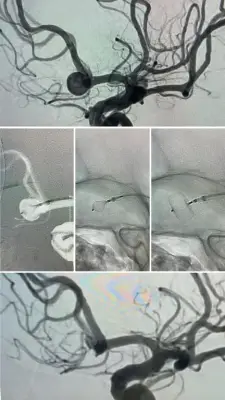 مستشفى المانع بالدمام يحقق إنجازًا طبيًا بتطبيق تقنية حديثة لعلاج تمدد شرياني دماغي