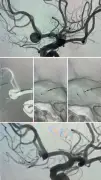 مستشفى المانع بالدمام يحقق إنجازًا طبيًا بتطبيق تقنية حديثة لعلاج تمدد شرياني دماغي