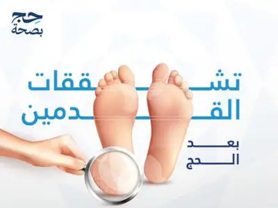 مدينة الملك عبدالله الطبية تحذر من تشقق القدمين بعد الحج وتقدم نصائح للعناية