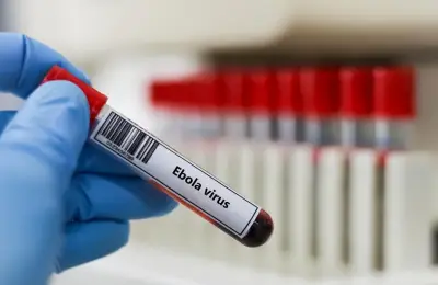 فرنسا تؤكد أول إصابة بإيبولا لطبيب عائد من الكونغو وحالته مستقرة