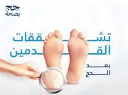 مدينة الملك عبدالله الطبية تحذر من تشقق القدمين بعد الحج وتقدم نصائح للعناية