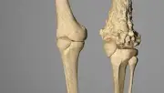 استشاري: أعراض سرطان العظام تشمل نزول الوزن وتغير لون الجلد