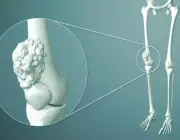 مستشفى الملك عبدالعزيز يحذر من تجاهل آلام العظام المستمرة
